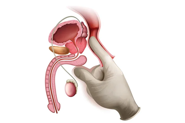 Varicocele Repair