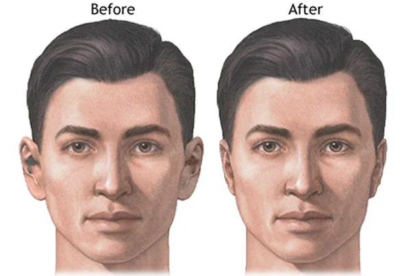 Ear Correction Surgery