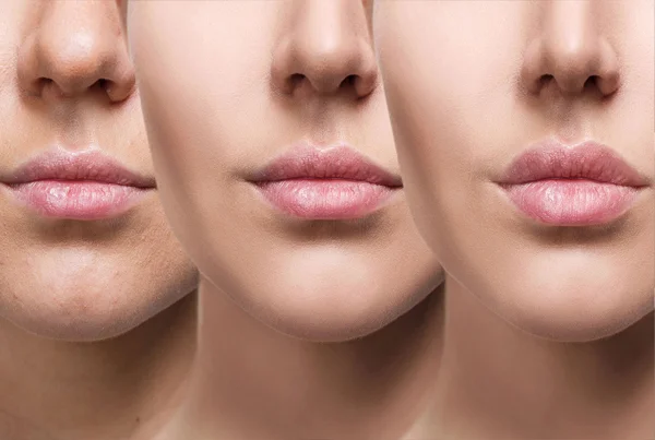 Lip Augmentation Surgery