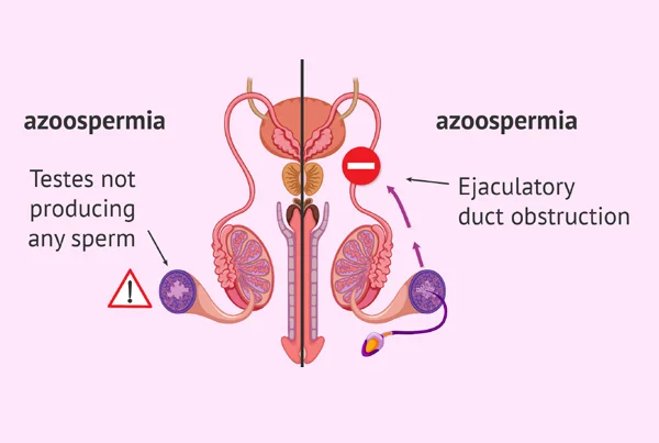 Oligospermia/Azoospermia