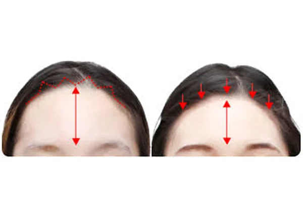 Forehead Reduction