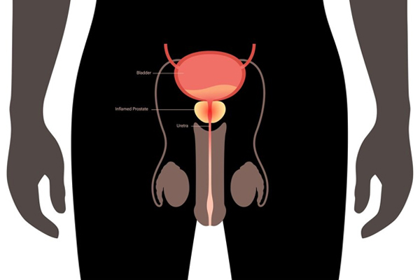 Laser Prostate & Stone Surgery