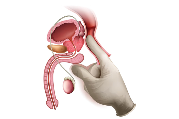 Varicocele Repair
