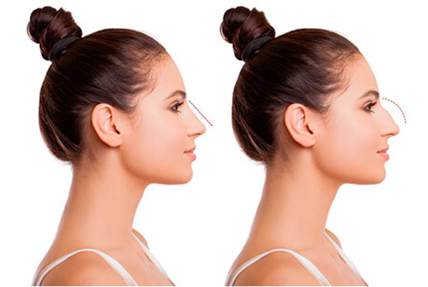 Rhinoplasty