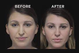 Scar Correction Surgery