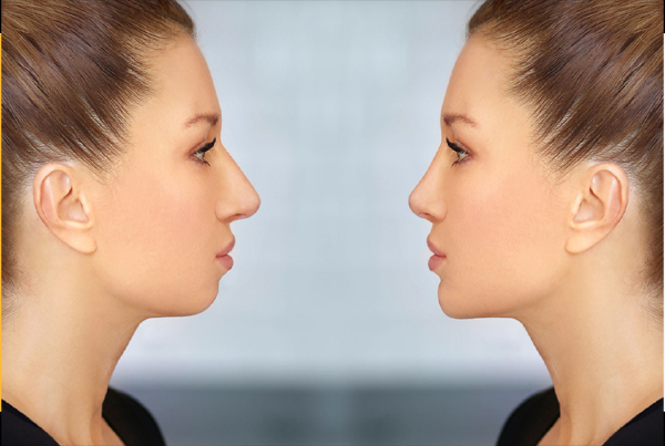 Chin Surgery