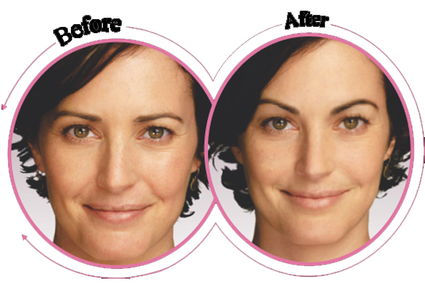 Brow Lift Surgery