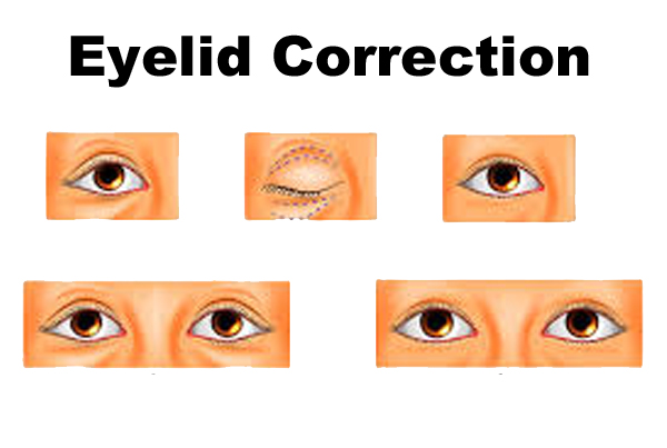 Eyelid Correction