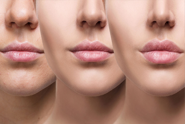 Lip Augmentation Surgery