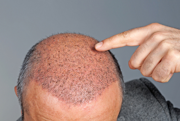 Hair Transplant