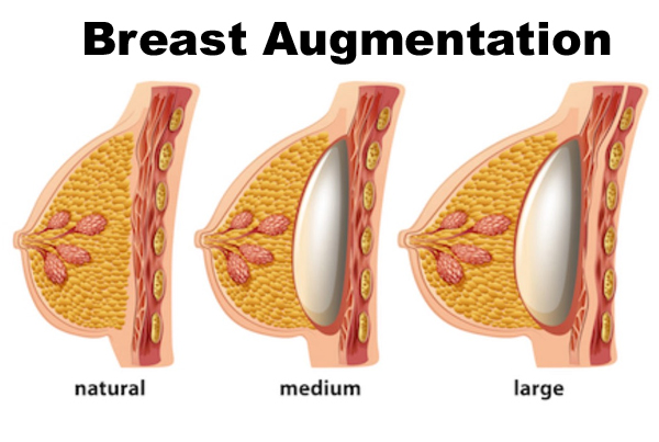 Breast Augmentation