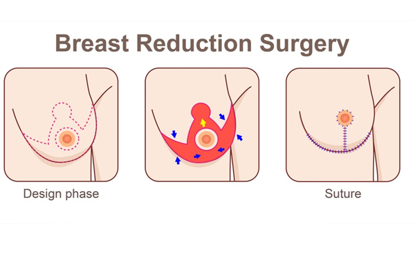 Breast Reduction