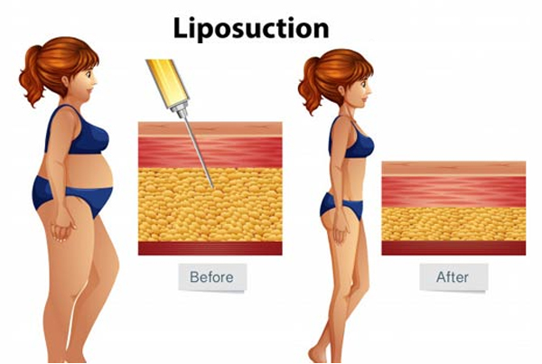 Liposuction