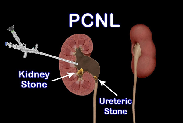 Percutaneous Nephrolithotomy Surgery (PCNL)