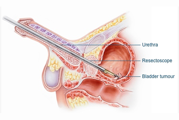 Transurethral Removal of Bladder Tumour Surgery (TURBT)