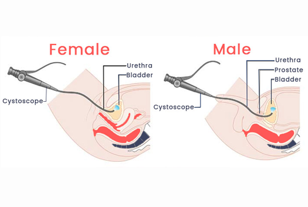 Optical Internal Urethrotomy (OIU)