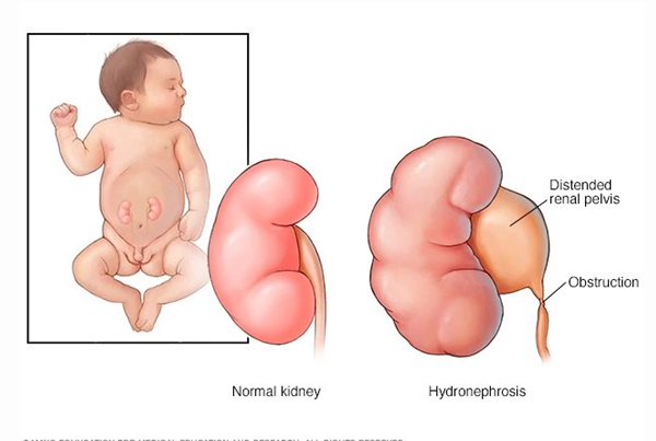 Pyeloplasty