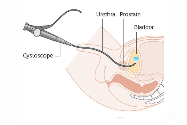 Cystoscopy