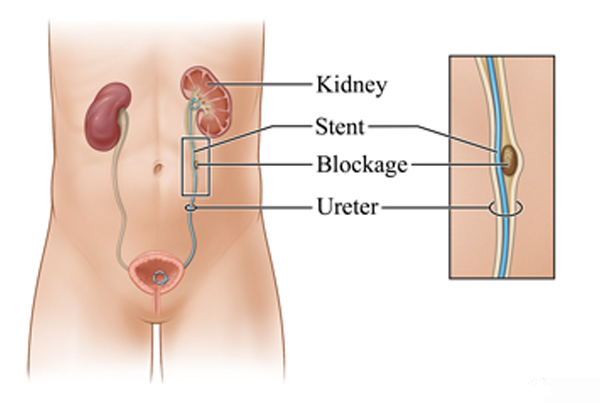 DJ Stenting Surgery