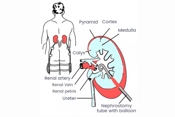 Percutaneous Nephrostomy Surgery (PCN)