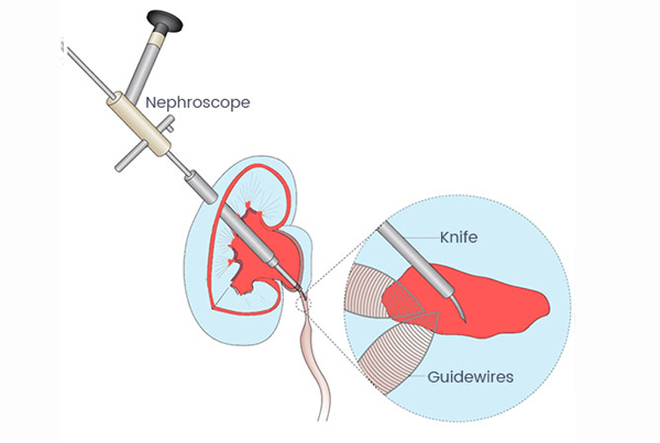 Endopyelotomy Surgery