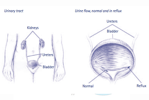 Ureteric Reimplantation Surgery