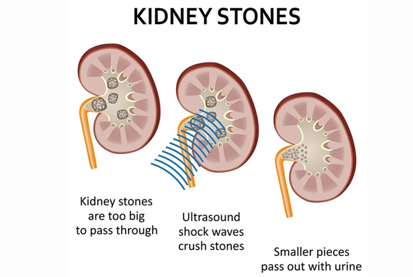 Kidney Stone Surgery