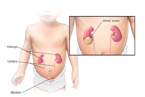 Childhood Renal Tumors