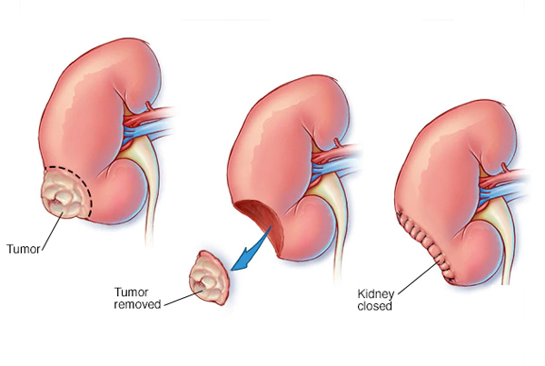 Radical Nephrectomy for Renal Tumors