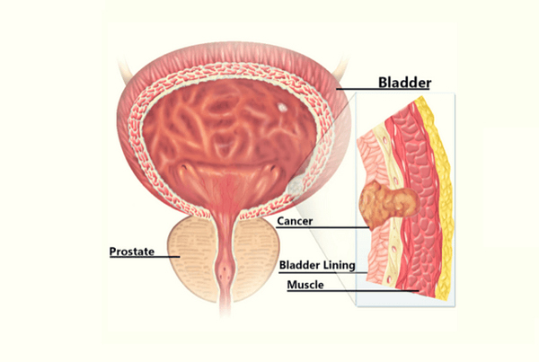 Bladder Tumor Surgery