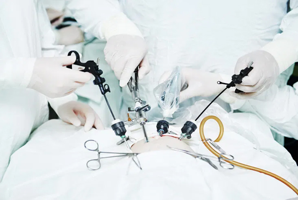 Laparoscopy Surgery