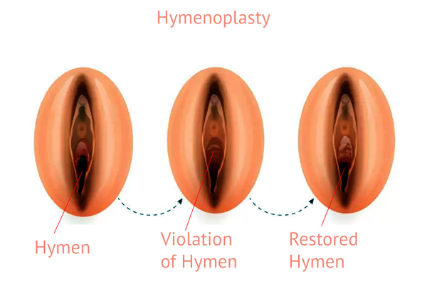 Hymenoplasty