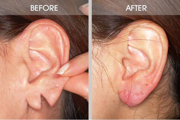 Earlobe Repair