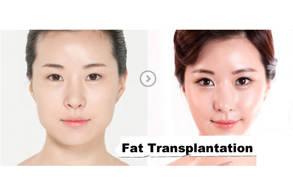 Fat Transplantation