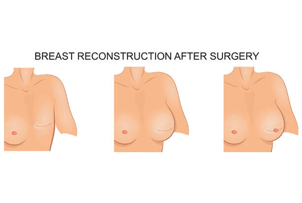 Breast Reconstruction