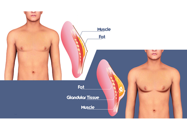 Male Breast Surgery