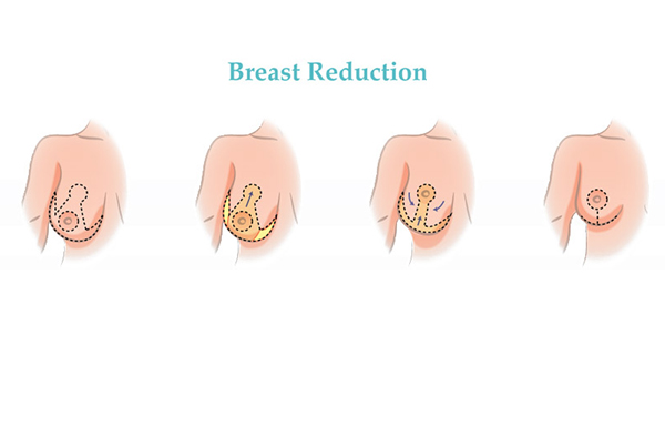 Breast Reduction and Lift Surgery