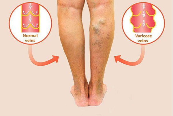 Laser Varicose Vein Surgery