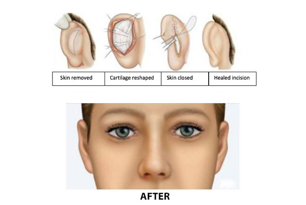 Ear Lobes Repair/Otoplasty