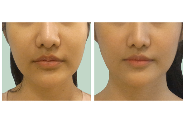 Lip Reduction Surgery