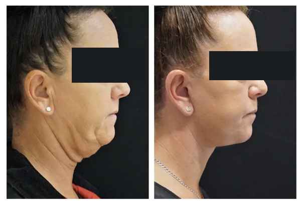 Neck Lift Surgery