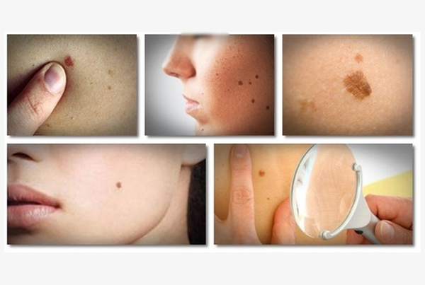 Removal of Mole, Wart and Birth Marks