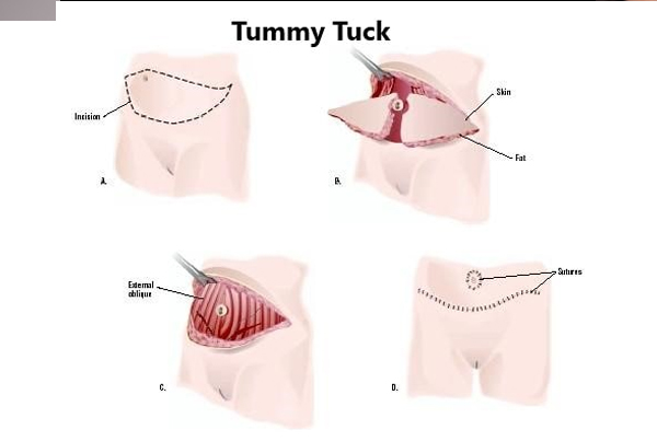 Tummy Tuck Surgery