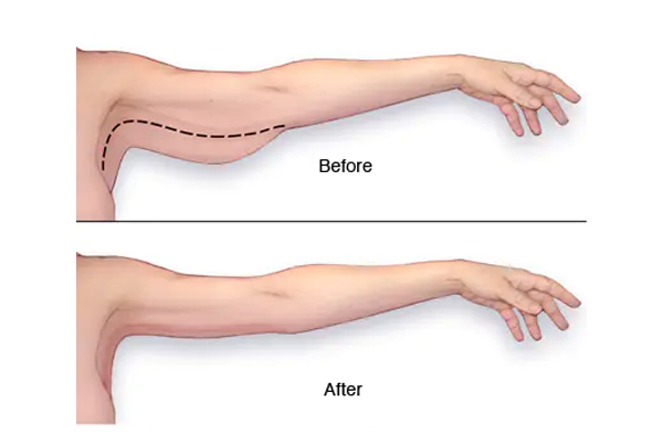 Arm Lift Surgery