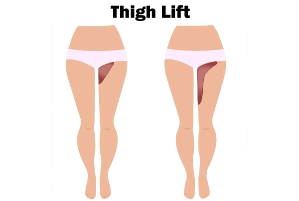 Thigh Lift Surgery