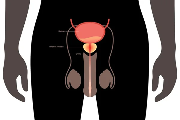 Laser Prostate & Stone Surgery