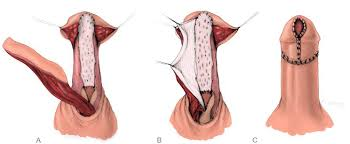 Best Urethroplasty treatment