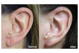 Best Earlobe Repair clinic