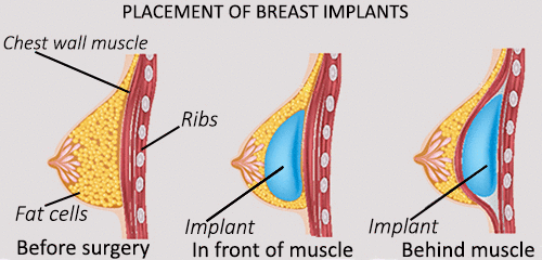 Breast Augmentation Surgery