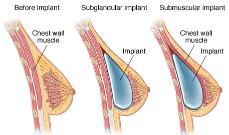 BREAST AUGMENTATION